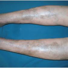 Image result for Pigment stains on the shin
