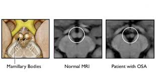 Find 33 ways to say sleepy, along with antonyms, related words, and example sentences at thesaurus.com, the world's most trusted free thesaurus. How Does Sleep Apnea Impact The Brain