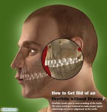 How to correct overbite naturally. How To Straighten Teeth By Yoga Teethwalls