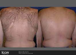 After laser hair removal, it is normal to experience redness in the treatment area. Laser Hair Removal Chicago Il Chicago Breast Body Aesthetics