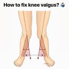 Sounds On And Don T Forget To Swipe Have You Experience During Walking Or Squatting That Your Knees Caving I Bow Legged Correction Knock Knees Bow Legged