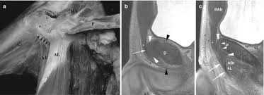 Image result for Pubic Apophysitis