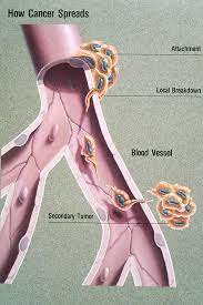 Metastatic Cancer How Long Can You Live Hpv Causes In Females Is A Wart A Virus Or Fungus