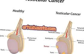 Namun, mustahil untuk anda menentukan sama ada ketulan tersebut bersifat. Semua Yang Anda Perlu Tahu Mengenai Kanser Testicular Gejala Dan Punca