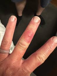 Image result for Chilblains