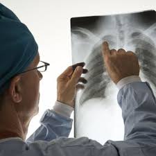 Lungenentzundung Pneumonie Symptome Behandlung