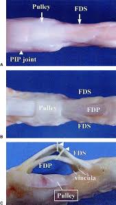 Flexor digitorum superficialis (flexor digitorum sublimis) is an extrinsic flexor muscle of the fingers at the proximal interphalangeal joints. Effects Of Superficialis Tendon Repairs On Lacerated Profundus Tendons Within Or Proximal To The A2 Pulley An In Vivo Study In Chickens1 Journal Of Hand Surgery