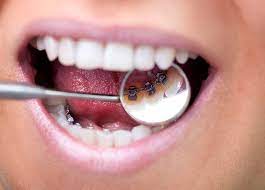 Ceramic braces blend in with your natural teeth and are not visible. How Much Do Braces Cost