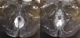 Image result for Ischiorectal Abscess