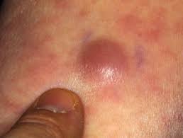 Leukaemia cutis | DermNet NZ