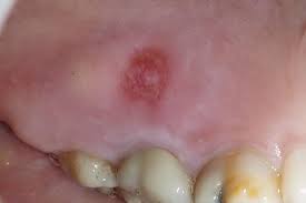 Image result for Canker sores symptoms roof of the mouth