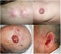 Image result for Merkel Cell Carcinoma