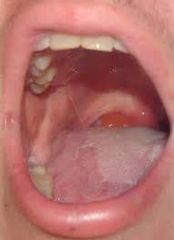 Image result for Uvulitis