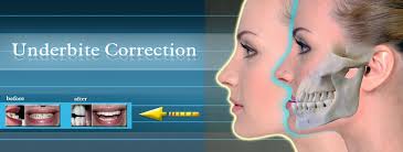 Different treatments options are available that dentists have used in the past to fix. Underbite Correction Without Surgery Kurpis Advanced Dentistry