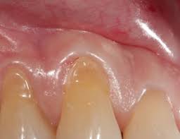 You have the best chance for successful treatment when you. Treatment For Gingivitis By A Periodontist Shine Dental Associates