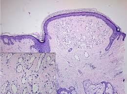 Due to their bright appearance, your doctor or dermatologist should be able to tell you have a cherry angioma without needing to do any extensive testing. Cherry Angiomas On The Scalp Semantic Scholar
