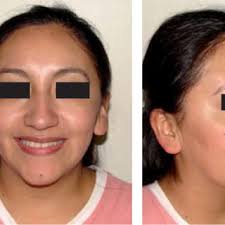 PDF) Corrección de mordida abierta mediante intrusión de molares con  mini-implantes