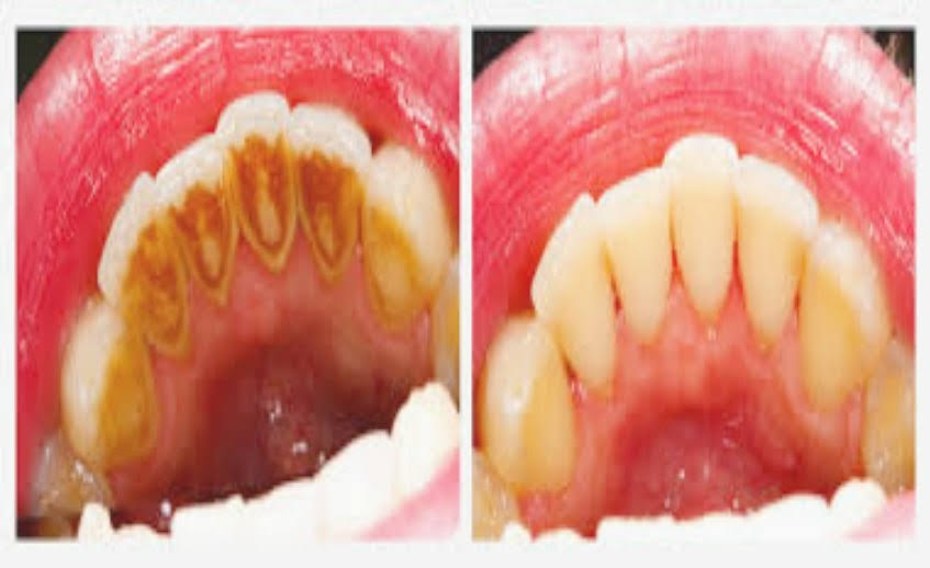 Teeth Cleaning product image
