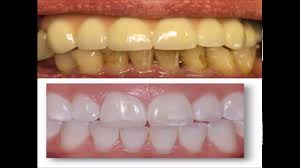 Sometimes our bodies react to the things we put in (or on) them, and things can get ugly. How To Remove Yellow Stains From Teeth At Home Remove Yellow Stains Teeth Stain Remover Stained Teeth