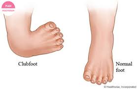 Mesin urut tapak kaki gintell. Masalah Kaki Bayi Bengkok Ctev Flexphysiotherapy