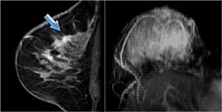 What does breast cancer look like on a mammogram? The Radiology Assistant Mri Of The Breast
