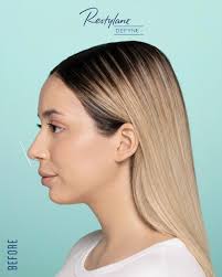 Did you know... VI Peel is the #1 Chemical Peel for Confident Skin, and  over 10 million VI Peels have been sold worldwide? Chemical peels use a  chemical solution to remove layers