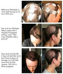 Whole30 Success Story Jessica O The Whole30 Program Whole30 Program Body Focused Repetitive Behavior Success Stories
