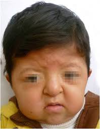 Expresividad variable en el síndrome de acrocefalosindactilia tipo I. A  propósito de dos pacientes