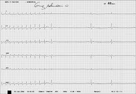 Elektrokardiogramm oder tägliche überwachung des ekg nach holter bei myokarditis. Https Www Kup At Kup Pdf 11496 Pdf