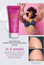 Bio Oil Results On Stretch Marks Before And After Nakedproof End Of The Line Stretch Mark Minimizing Lotion Best Stretch Mark Creams Stretch Mark Cream Stretch Marks