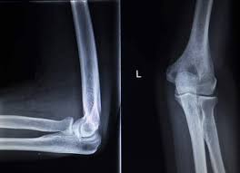 Ein tennisarm entsteht durch eine überlastung der muskeln. Tennisarm Behandeln Diagnose Therapie In Heppenheim Bergstrasse