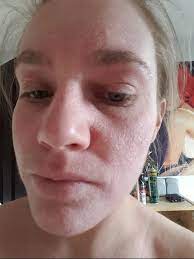 Face Is Super Dry And Flakey Hello Everyone First My Skin