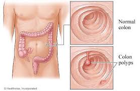 But over time, some colon polyps can develop into colon cancer, which is often fatal when found in its later stages. Colonoscopia Te SalveazÄƒ De Hemoroizi