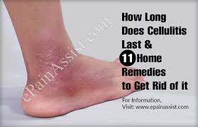 How Long Does Cellulitis Last 11 Home Remedies To Get Rid Of It Home Remedies Remedies Cellulitis Remedies