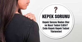 Kepek Sorunu Neden Olur Ve Nasil Tedavi Edilir Kepek Aloe Sampuan