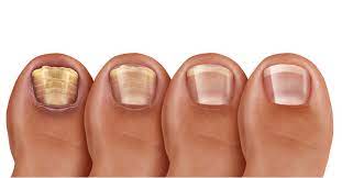 تعرف على لون الأظافر بالصور ويب طب