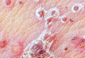 More information on the types of herpes is below. Genital Herpes Treatment At Home Hsv 2 Online Treatment Herp Alert
