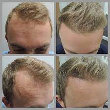 Hair Transplant Cost In Lahore Hair Transplant Hair Transplant Cost Rhinoplasty