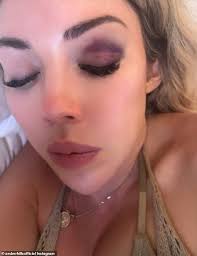 Aussie tourist's chilling warning after waking in a strange Bali villa with  a black eye and no memory