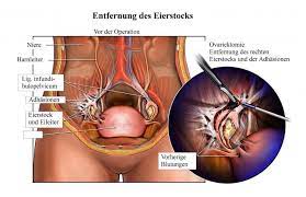 Hysterektomie Operation Gebarmutterentfernung Abdominal Folgen Dauer