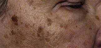 Image result for Solar Lentigo