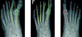 Image result for Hallux Varus