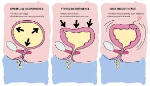Image result for Overflow Incontinence