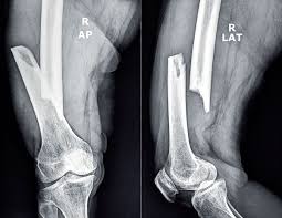 Image result for Fracture XRay