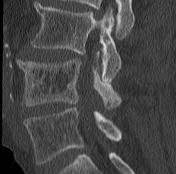 For that person with an active lifestyle. Picture Frame Vertebral Body Radiology Reference Article Radiopaedia Org