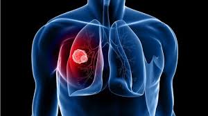 Lung cancer symptoms