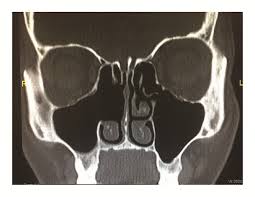 Image result for Maxillary Sinus