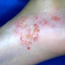 Image result for pompholyx soles of feet