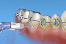 Occasionally they'll take your braces all the way off before their finished and send you over to your regular dentist to get your gums and teeth. What Is A Water Pick And How To Clean My Teeth With It Dental Braces Water Pick Braces