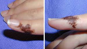 This is the basis for elastography. Benign Skin Lesions Amboss